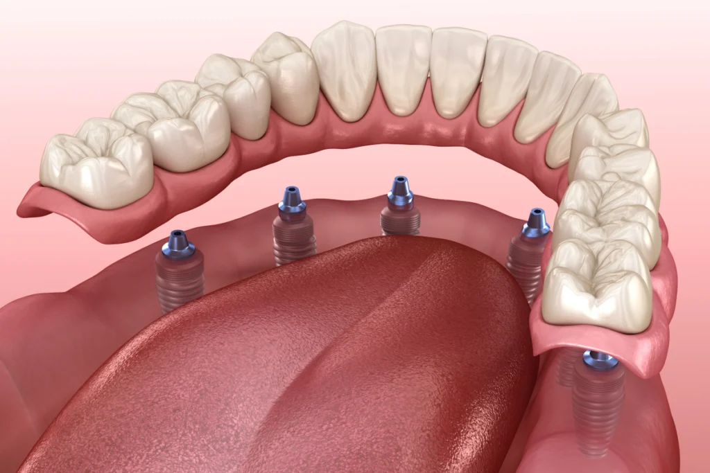 Prothèse fixe complète illustrée sur une arcade implantée