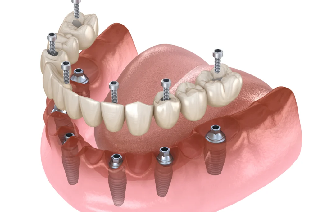 Illustration d'une arcade dentaire portée par plusieurs implants distincts