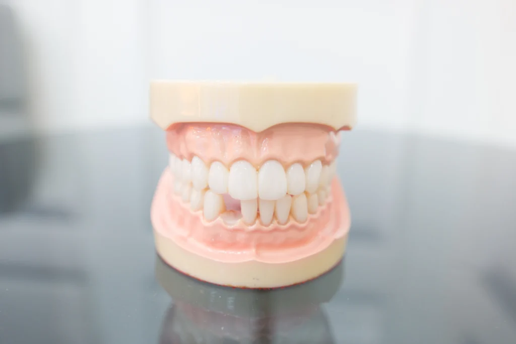 Modèle dentaire présentant un implant dentaire unitaire